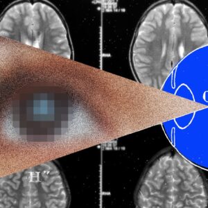 041224 Science Brain Implant Vision.jpg
